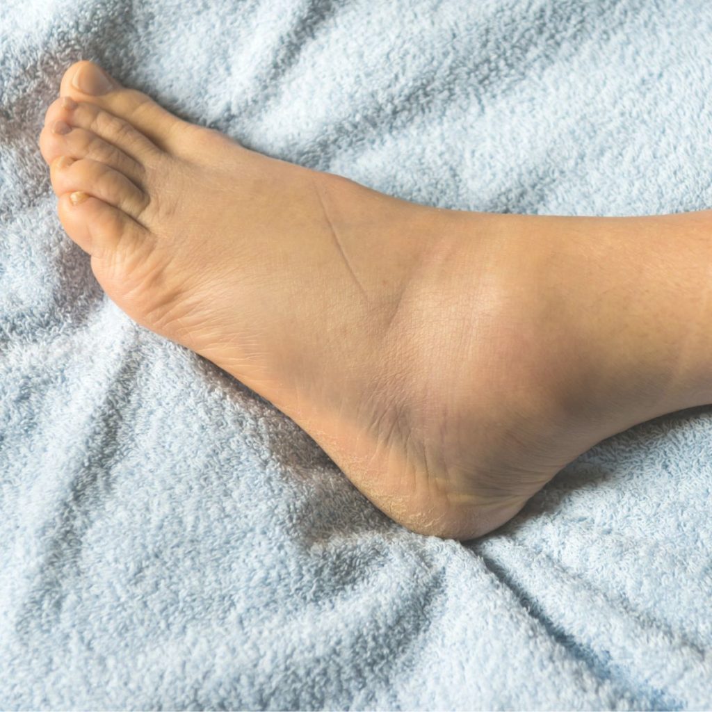 high ankle sprains